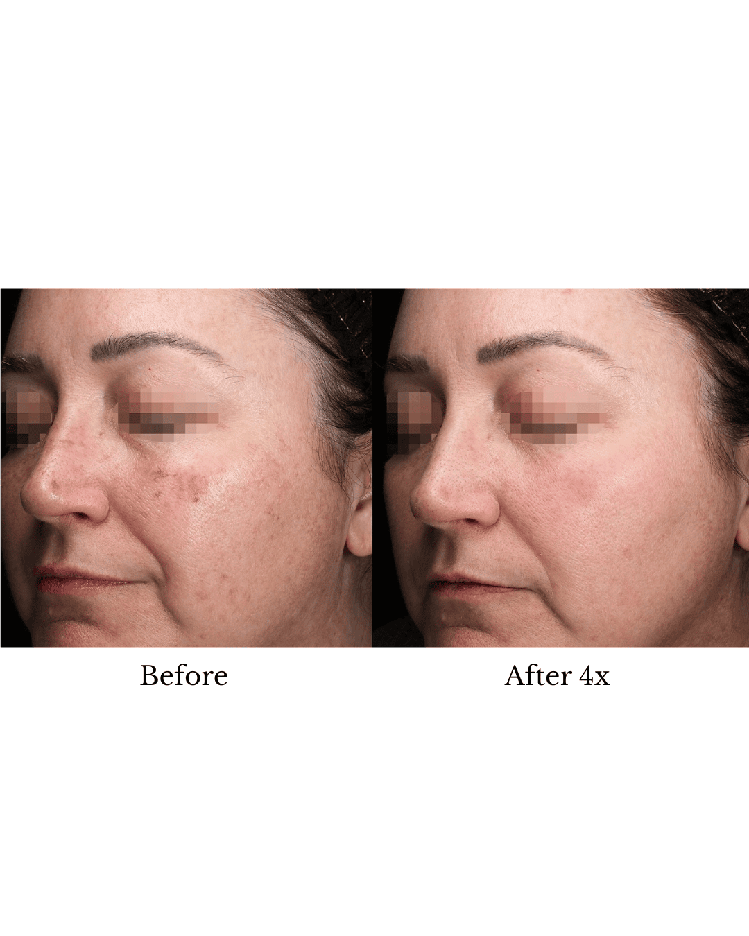 Alma Harmony Before and After Results; less spot pigments, and improved pores.