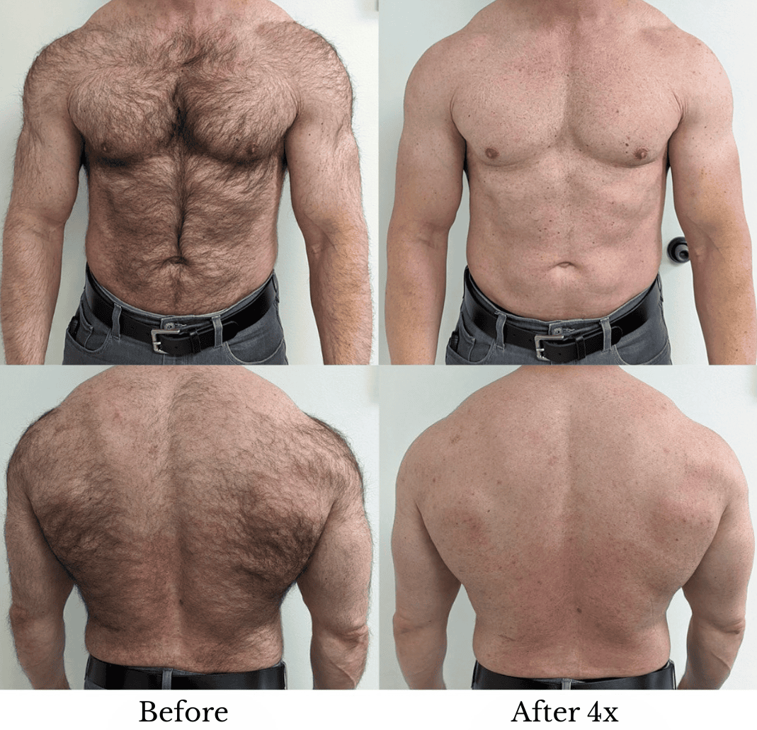 Image of Man's chest and back before and after laser hair removal, incredible change. No hair. 