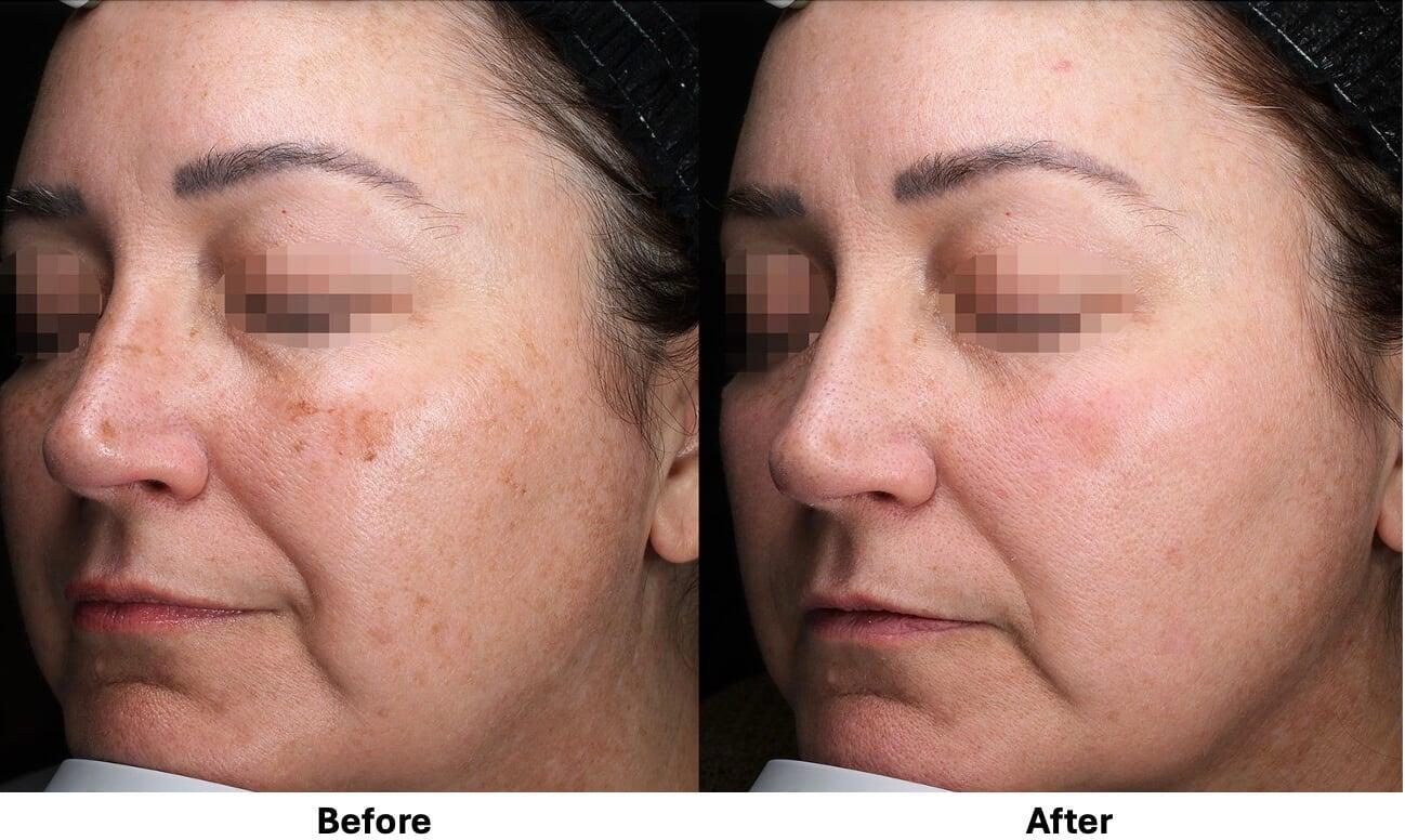 Before and after Alma Harmony™